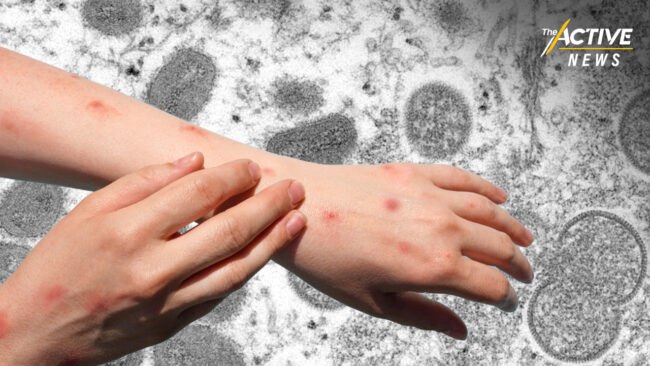 ผู้ป่วยฝีดาษวานร​ คนแรก แผลตกสะเก็ด​แล้ว​ ยังไม่พบติดเชื้อเพิ่ม