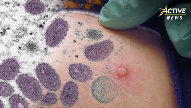 พบชายป่วย ”ฝีดาษลิง” คนที่ 2 ในกรุงเทพฯ สัมผัสเสี่ยงสูง 10 คน