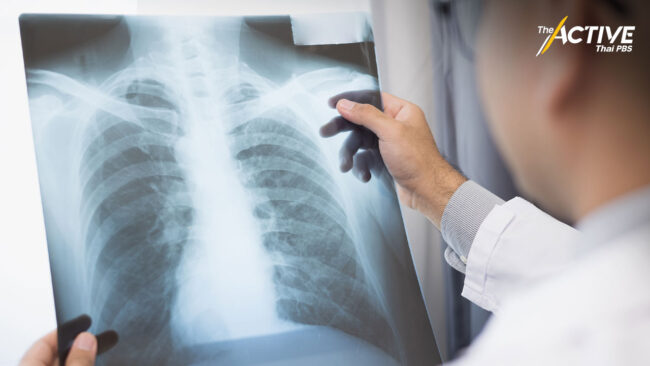 เปิดสถิติคนไทยป่วยมะเร็งปอด ตายเฉลี่ย 40 คน/วัน
